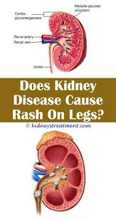 Pin On What Is Kidney Disease