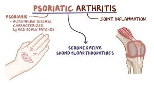 Whatever you need, whatever you want, whatever you desire, we provide. Psoriatic Arthritis Video Explanation Osmosis