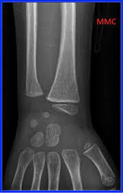 Fracture En Motte De Beurre Imaging Consult