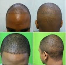 Fue is a hair transplant method of extracting, or harvesting, donor hair in a follicular unit hair transplant procedure. African American Fue Hair Transplant Dermhair Clinic 1 310 318 1500