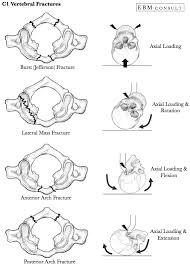 A yamaha grand piano model. C1 Vertebral Jefferson Fractures General Review