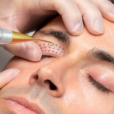 Best Plasma Pen Treatment in Dubai & Abu Dhabi | Esthetic Clinic
