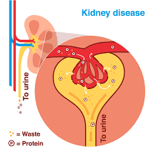 People with chronic kidney disease may help slow the progression or kidney disease or prevent kidney failure by lowering protein,potassium and phosphorus intake to help kidneys. Diabetic Nephropathy Kidney Disease Diabetes Uk
