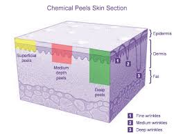 Chemical Peels Lactic Glycolic Acid Tca Phenol Information