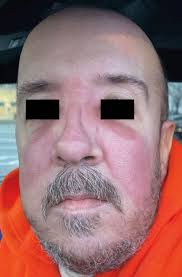 1786. Kerion is caused by a. Candida b. Streptococcus c. Dermatophytes d.  Herpes