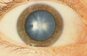 Stem Cells Regenerate Human Lens After Cataract Surgery Restoring Vision Approach May Have Broad Therapeutic Implications On Tissue And Organ Repair Cataract Cataract Surgery Eye Surgery