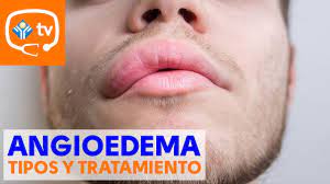 Angioedema Tipos Y Tratamientos Youtube