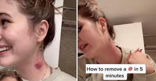 How do you get rid of a hickey bruise? Want To Know How To Get Rid Of A Hickey Let Tiktok Be Your Muse