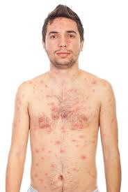 Jul 15, 2015 · sonst geht es meist darum, die symptome zu lindern, etwa den juckreiz durch den ausschlag. Windpocken Bei Erwachsenen Symptome Und Behandlung Vitaloo
