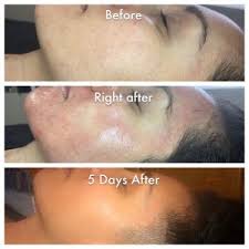 Want to microneedle your skin at home with a microneedling pen but don't know where to begin? When Should You Pick Nanoneedling Over Micro Needling Fashion News And Health Blogging Updates