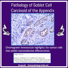 Pathology Of Goblet Cell Carcinoid Of The Appendix Educational Gif Pathology Education Cell