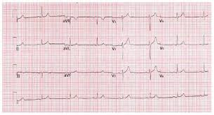 Image result for Early Repolarization