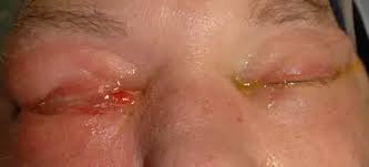 If you have any of the following conditions, you may be more likely to get nasal polyps What Happens If We Don T Treat Nose Polyps Quora