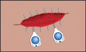 Dermaclose A Great Alternative To A Skin Graft
