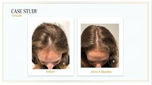 First of all, if you suspect thinning hair or hair loss, take a deep breath and relax. I Tried It Harklinikken The Scandinavian Hair Growth System Everyone S Buzzing About