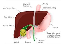 Este produsa de mobilizarea calculilor in caile biliare. Litiaza Biliara Reginamaria Ro