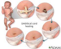 An umbilical granuloma is a moist, red lump of tissue that can form on a baby's navel (belly button). Umbilical Cord Care In Newborns Information Mount Sinai New York