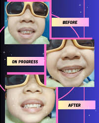 Cute girl very cooperative with dental procedure , she's very happy after  restoration 🥰 Looks more cuter 🥰 , #dentalcare, #dentist, #DentalClinic,  #dentalclinicss15, #dentalngandng, #toothrestoration ...