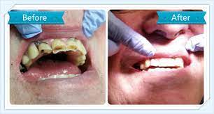 We provide obligation free dental exam. Composite Filling Veneer Smile Dental Ranui Dr Ala Al Attar Auckland Dentists