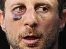 The views & opinions expressed here do not reflect those held by max scherzer. Max Scherzer Is Max Scherzer Even With A Broken Nose Scherzer Ks 10 Throws Seven Scoreless Vs Phillies Federal Baseball