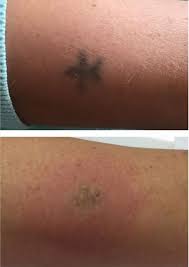 Patient comfort, safety and discretion is our priority, where we strive to always deliver and maintain the highest standards in patient care. Laser Tattoo Removal The House Of Nails