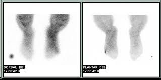 Image result for Osteomyelitis Bone Scan