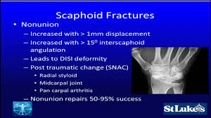 Image result for Scaphoid Fracture