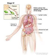 I am in the same situation. Colon Cancer Treatment Mhealth Org