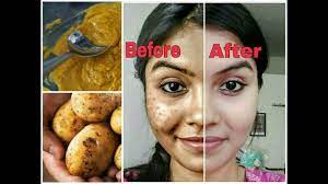 A trendy remedy for dark spots on the face is lemon juice. Remove Dark Spots In Just 7 Days 100 Natural Get Rid Of Uneven Skintone Youtube