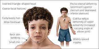 Noonan Syndrome American Family Physician