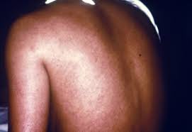 Ebola is a rare but deadly virus that causes fever, body aches, and diarrhea, and sometimes bleeding inside and outside the body. Viral Hemorrhagic Fevers Knowledge Amboss