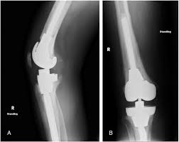 52459 inden/altdorf (0) rechtsanwalt inden/altdorf. The Use Of Trabecular Metal Cones In Complex Primary And Revision Total Knee Arthroplasty The Journal Of Arthroplasty