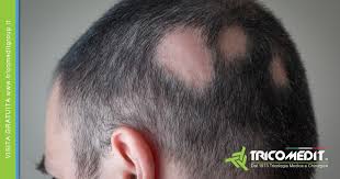 Zach a 20 anni ha notato che i suoi capelli iniziavano a diradarsi e ha . Alopecia Areata Cause E Cure Centro Tricologico Tricomedit Group