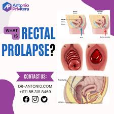 Image result for Rectal prolapse