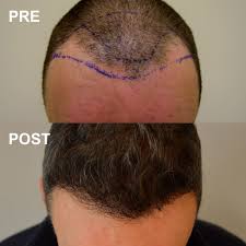 After 17 years in management at fedex, peter. L Autotrapianto Capelli F U E E Un Metodo Che Garantisce Standard Qualitativi Altissimi Sia Come Naturalezza Che Come Risul Capelli Stile Di Capelli Estetico