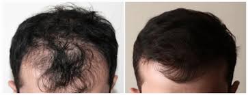 The level of hair loss though will be dependent on some very key factors. How Many People Lose Their Hair Hair Loss Statistics Dr Anthony Farole Dmd Facial And Oral Surgery Center