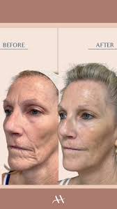 This beautiful transformation is the result of consistent, subtle  injectable treatments over the course of 2 years., Using a combination of:,  💉 Restylane-L with the fern technique to softly restore ...
