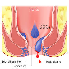 Image result for Hemorrhoid