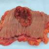 Throat cancer is a condition that is characterized by the development of malignant tumors in the throat (pharynx), voice box (larynx) or tonsils. 1
