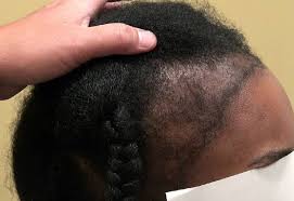 How to generate new hair follicles in a receded hairline. Tips On How To Grow Back Your Receding Hairline Eve Woman
