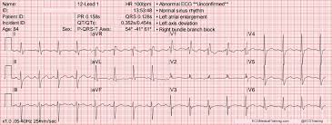 Large Block Method To Calculate Heart Rate Ecg Medical