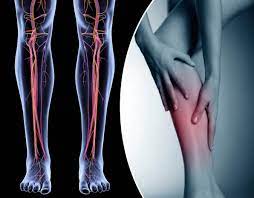 bacakta damar atmasi neden olur ve nasil gecer