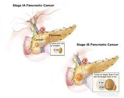 Surgery is available to about 20 percent of. Pancreatic Cancer Treatment Adult Pdq Patient Version National Cancer Institute