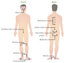 Image result for Poststreptococcal Reactive Arthritis