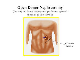 Kidney Donation Surgery And Recovery Weill Cornell Medicine