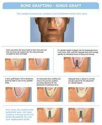 Plastic Surgery Associates Provide Sinus Lift Grafting You Must Know More About Here Http Www Drdonpreble Com Services Html Dental Implants Dental Sinusitis