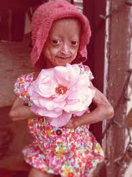 Las Enfermedades Mas Extranas Del Mundo Impactantes Casos Y Fotografias Guioteca