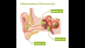Image result for Bacterial Labyrinthitis