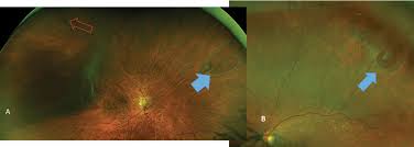 Retinal tears when a retinal tear or hole hasn't yet progressed to detachment, your eye surgeon may suggest one of the following procedures to prevent retinal detachment and preserve vision. A Field Guide To Retinal Holes And Tears