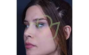 To undergo an eye surgery in a foreign country is a very hard decision. Temporal Lift Revital Clinical
